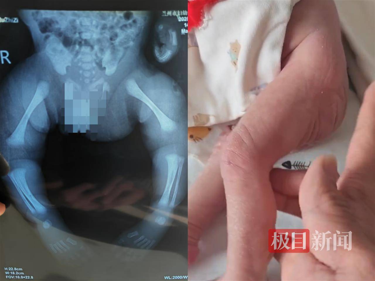 二胎出生查出先天性病症或落下残疾<strong></p>
<p>原油招聘</strong>,残疾父母称医院产检漏检、未尽告知义务,医院及医调委回应