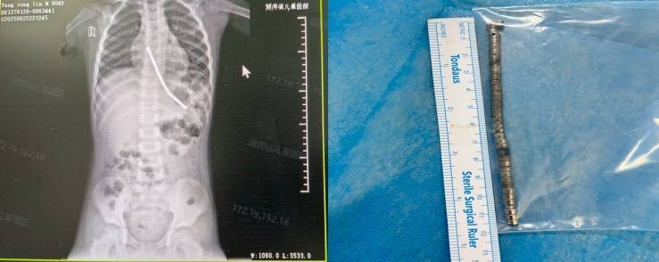 整整40颗<strong></p>
<p>原油后期走势</strong>!湖南3岁男童身体里取出……医生紧急提醒