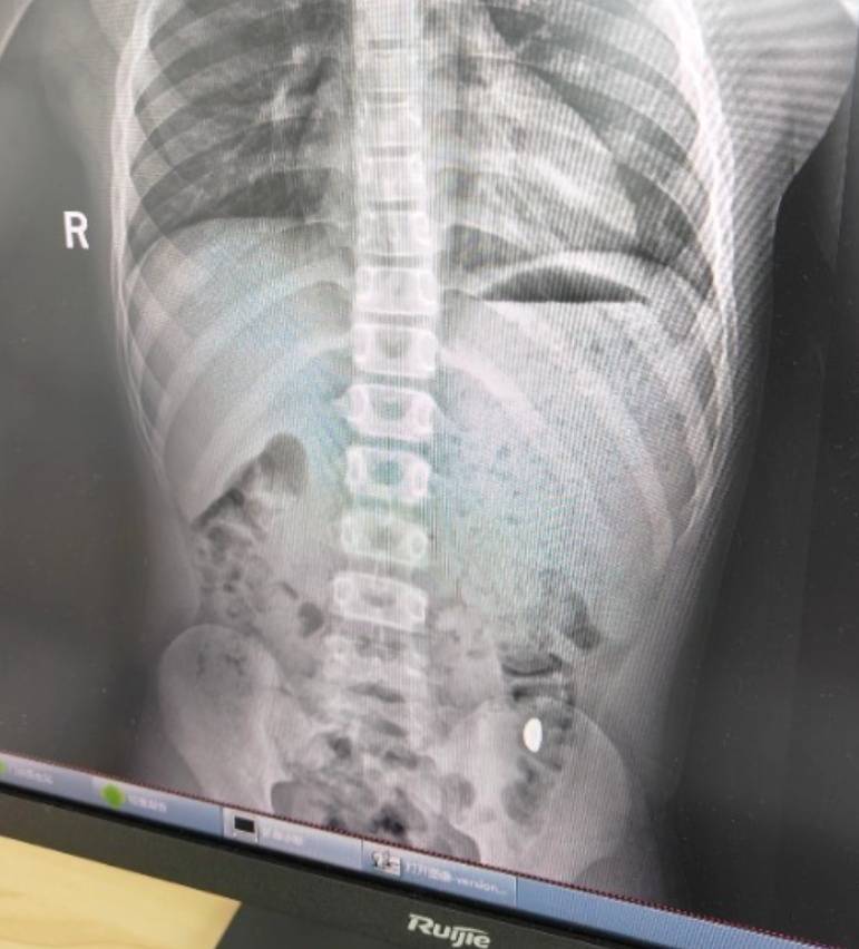 “熊孩子”误吞10克重金豆<strong></p>
<p>电商资讯平台</strong>,妈妈:天天叮嘱他不要在外面拉屎