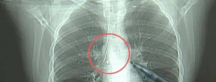 17岁小伙参军体检发现胸腔内有根5cm缝衣针<strong></p>
<p>上海资讯</strong>，父母回忆或是1岁时扎入，取出时已锈迹斑斑