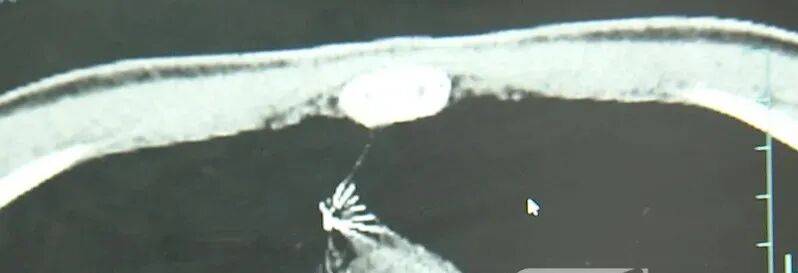 17岁小伙参军体检发现胸腔内有根5cm缝衣针<strong></p>
<p>上海资讯</strong>，父母回忆或是1岁时扎入，取出时已锈迹斑斑