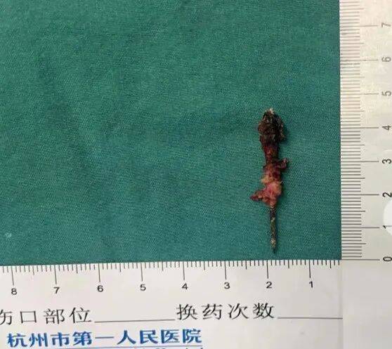 17岁小伙参军体检发现胸腔内有根5cm缝衣针<strong></p>
<p>上海资讯</strong>，父母回忆或是1岁时扎入，取出时已锈迹斑斑